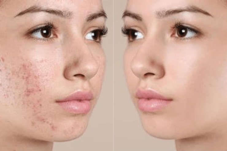 how-to-remove-acne-from